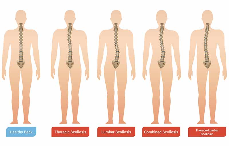 Why shouldn’t you rebound with Scoliosis?